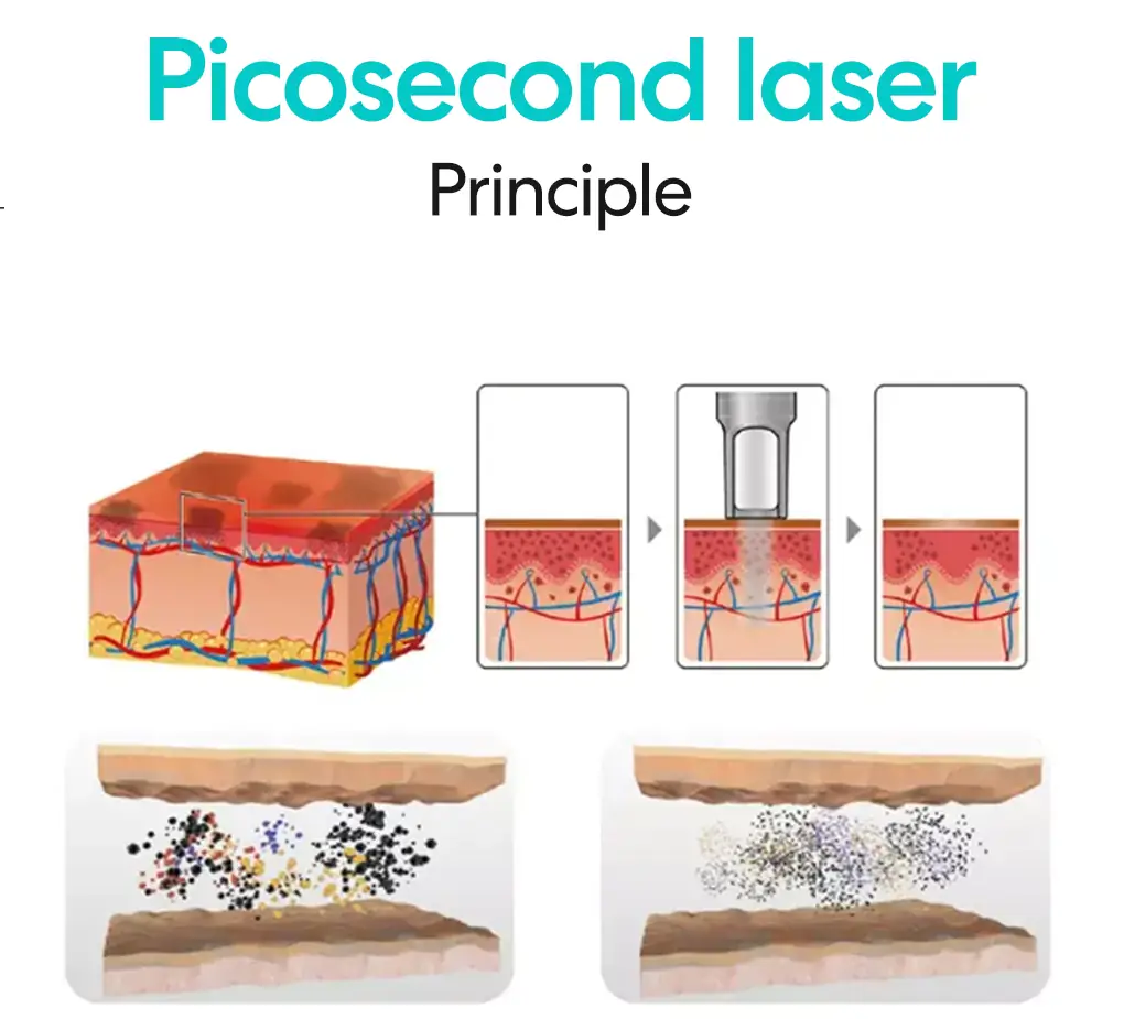 picosecond laser principle