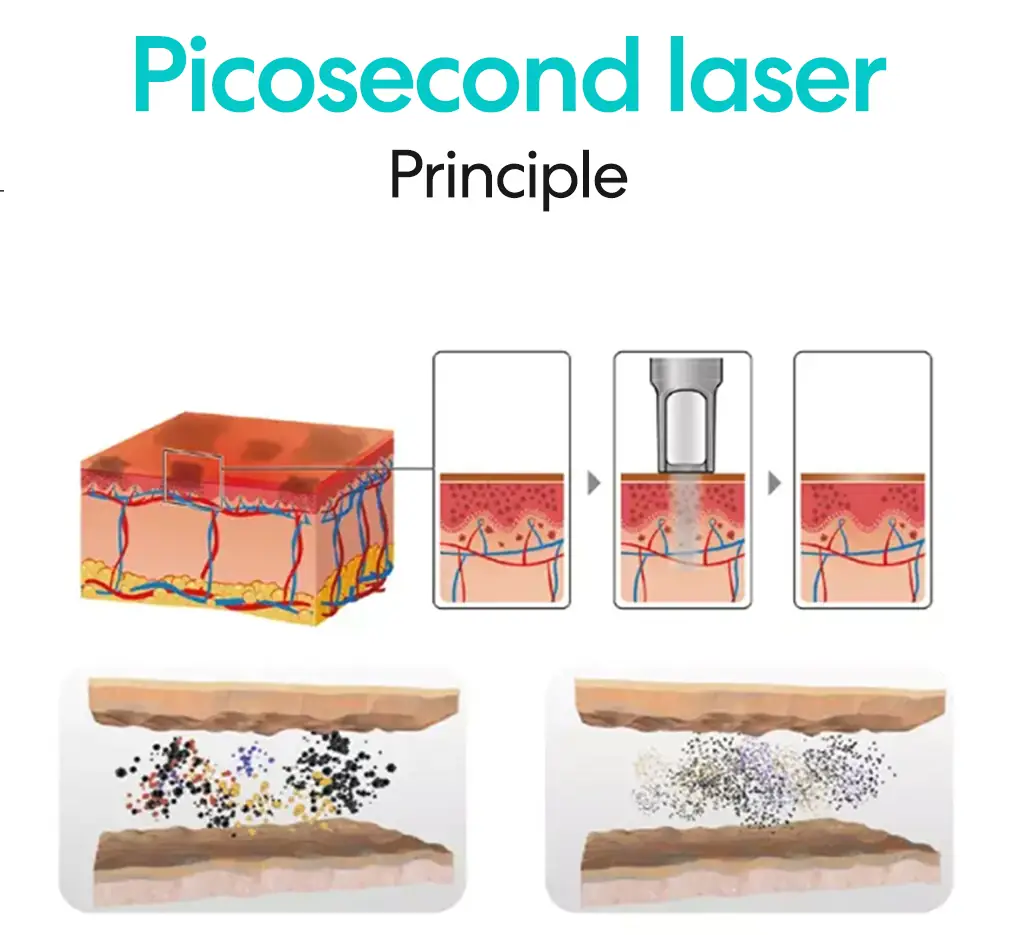 picosecond laser principle