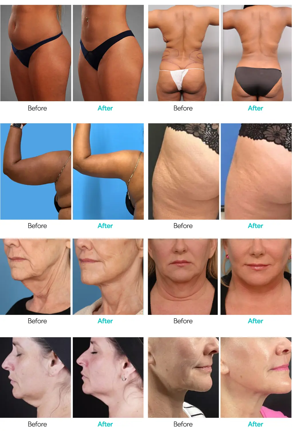 980nm diode laser before and after