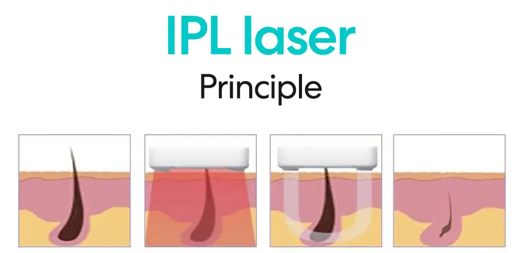 ipl working principle