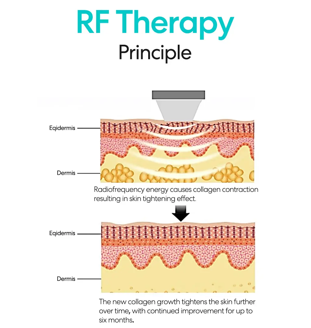 rf therapy principle