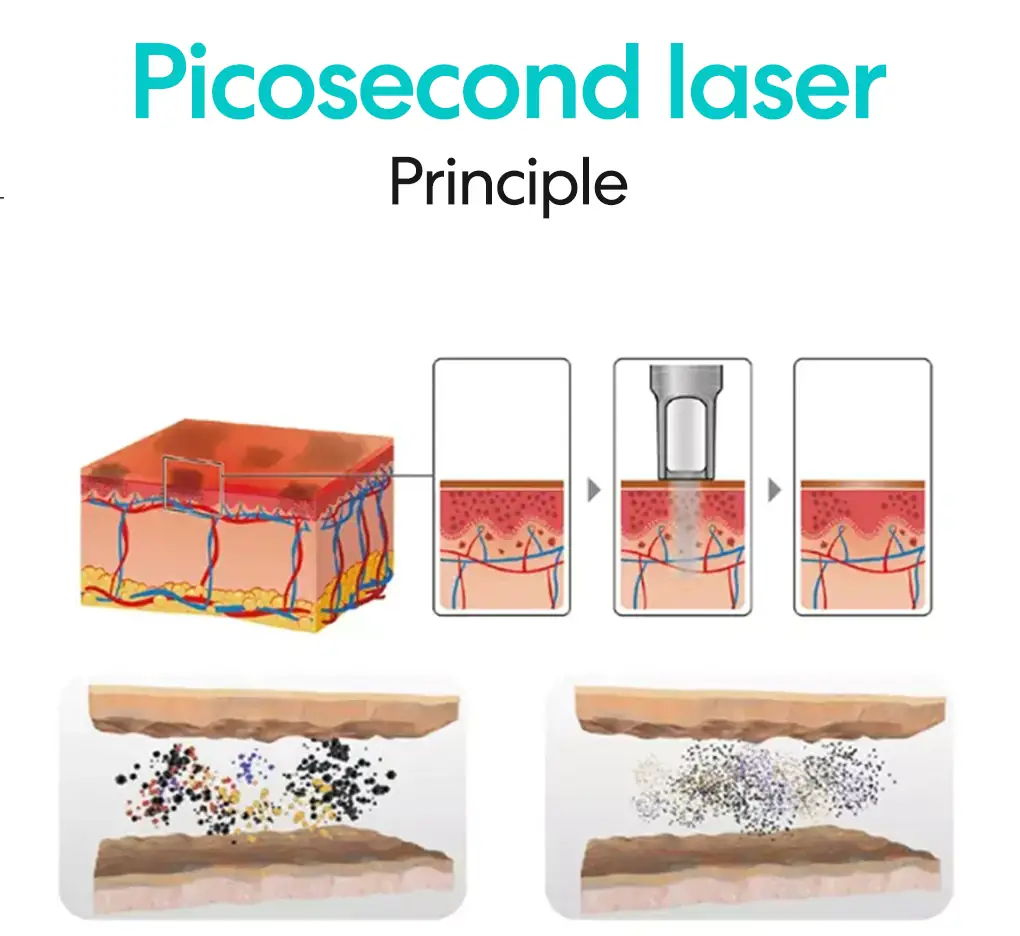 picosecond laser principle