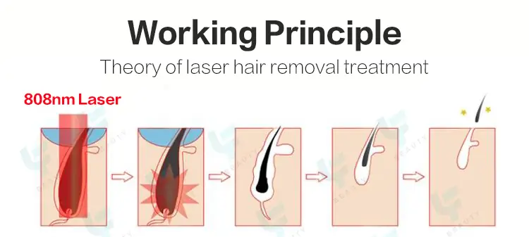 808 diode laser hair removal working principle