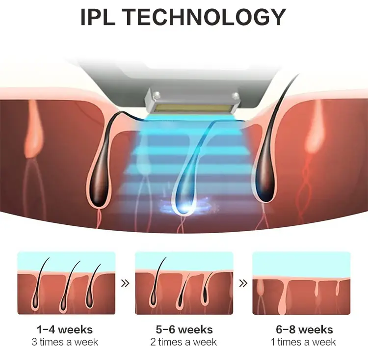 ipl hair removal