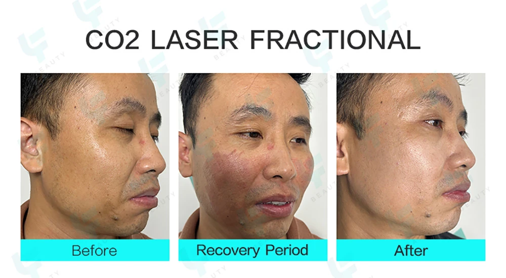professional co2 fractional laser machine for skin resurfacing vaginal rejuvenation 2026 guide (2)