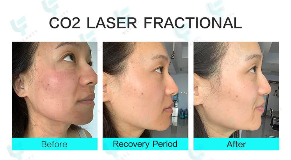 professional co2 fractional laser machine for skin resurfacing vaginal rejuvenation 2026 guide