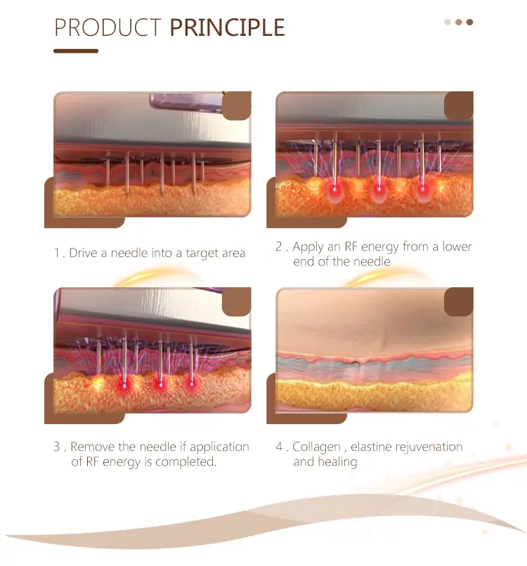 the principle of microneedling rf device
