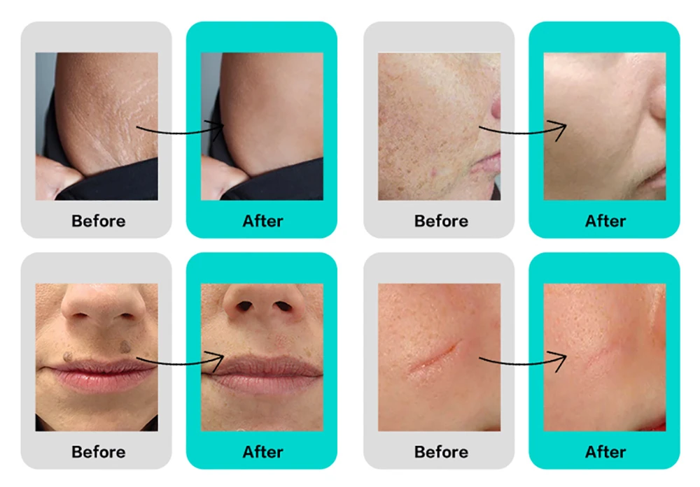 Before and after results of CO2 laser treatment for scars, wrinkles, and skin rejuvenation