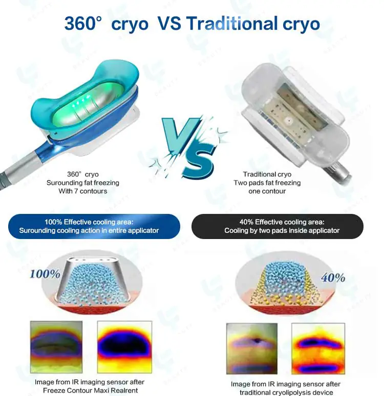 360° cryo vs traditional cryo