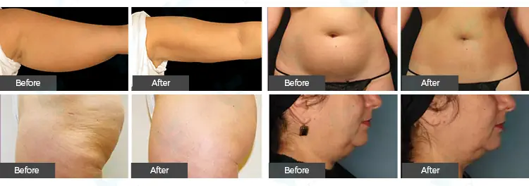 before and after