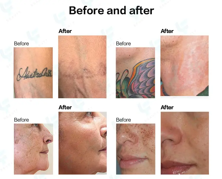before and after